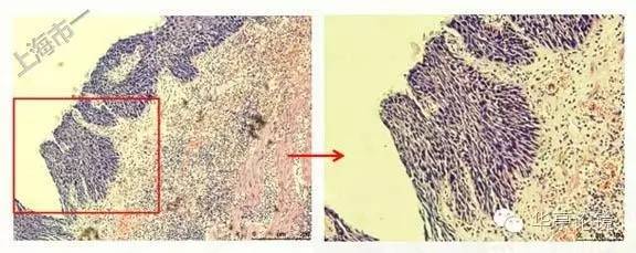 6个精彩病例带你领略早期食管癌的内镜下诊治