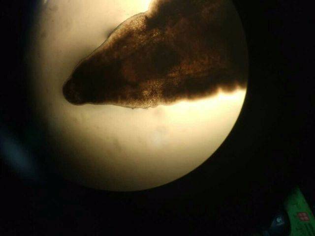 胆囊里面有虫怎么办,胆囊有虫什么症状