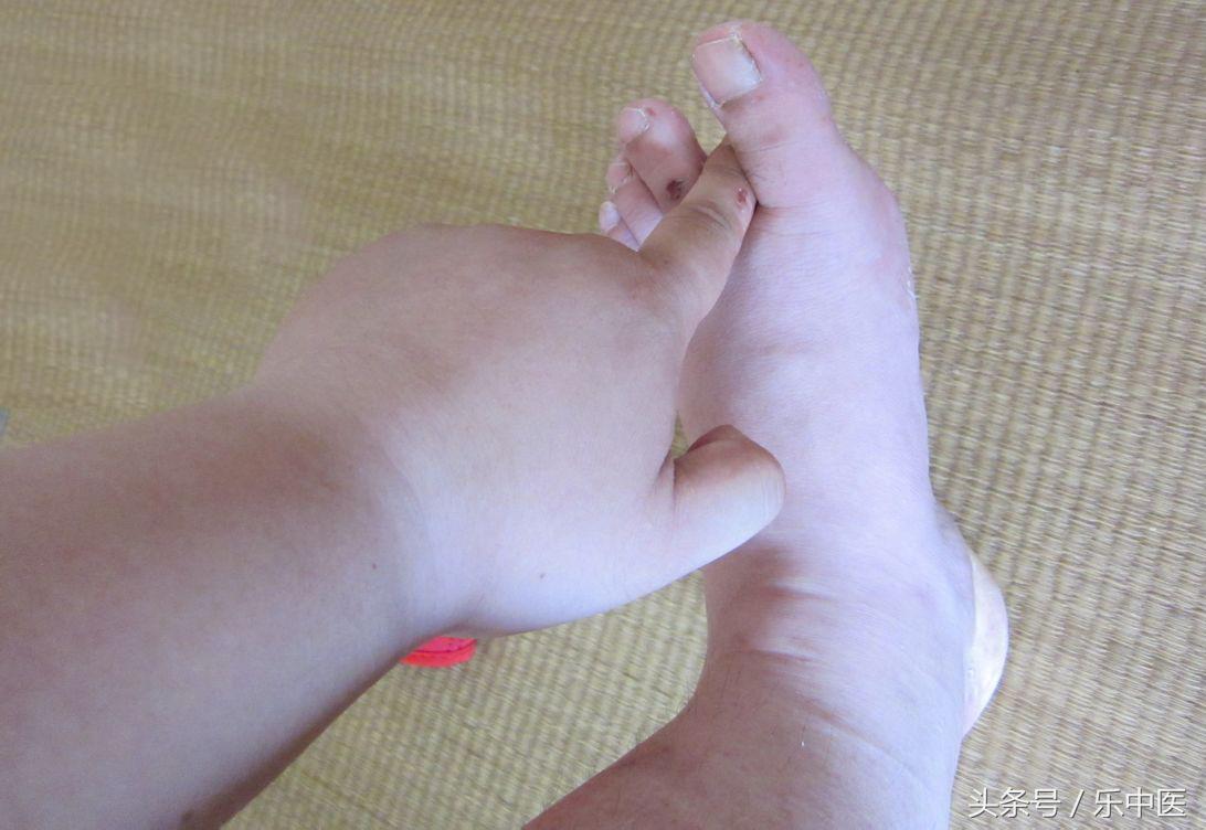 得了脚气很臭怎么办,得了脚气的四个阶段