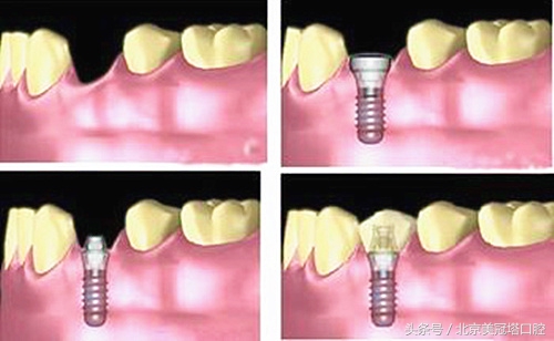 种植牙到底有多好,种植牙使用寿命10年需多少钱一颗