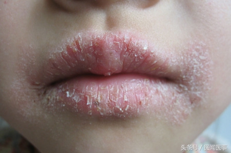 嘴唇一到秋冬就干裂,进入秋冬嘴巴老是干裂