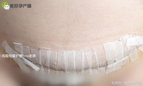 剖腹产纱布拆了需要继续消毒么,剖腹产的宝妈会阴消毒清洁多久