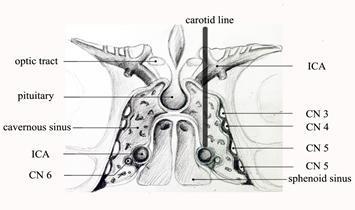 海绵窦海绵状血管瘤,海绵窦区海绵状血管瘤发病年龄