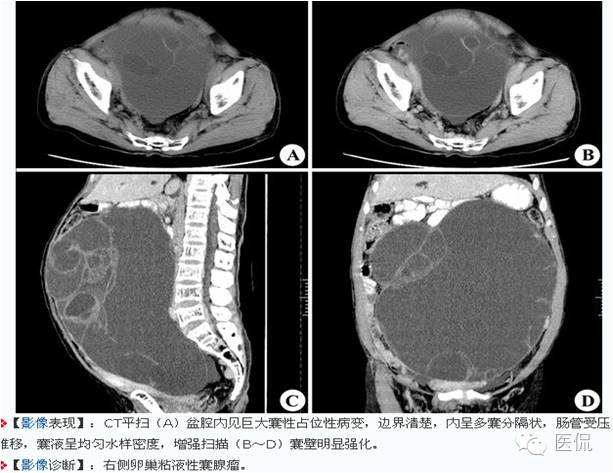 病例丨病理结果「医看」有奖阅片大赛病例资料8：右侧卵巢纤维瘤#医学影像#
