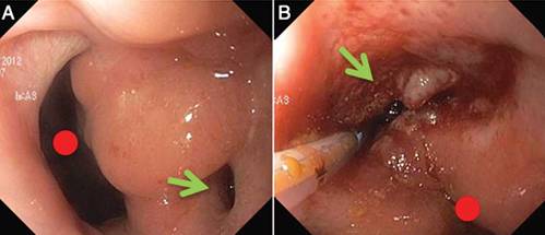 克罗恩病内镜严重程度指数,克罗恩病内镜检查是怎么样的