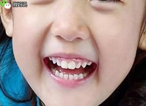 宝宝笑起来露牙龈是什么原因,6岁孩子露牙龈笑最简单改善方法