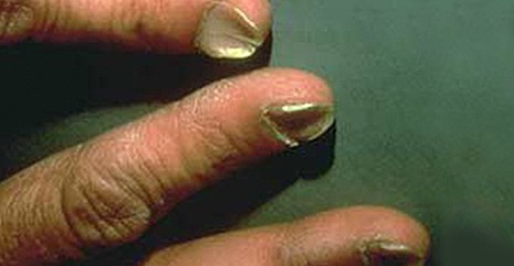 指甲的变化意味着身体的健康状况,当指甲发绿发脓的时候要怎么处理