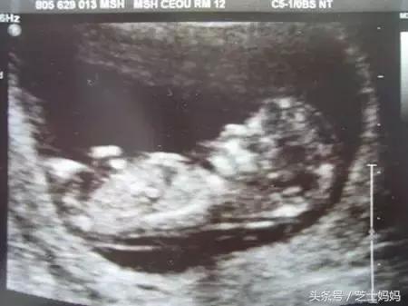 胎儿nt检查发现胸腔左侧有积液5mm,检查nt就是检查胎儿脑子有问题吗