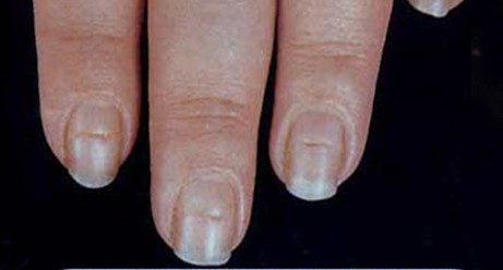 观手知健康指甲有白点怎么回事,当指甲发绿发脓的时候要怎么处理