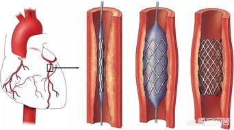 冠状动脉支架术后注意事项,冠状动脉粥样硬化支架后注意事项