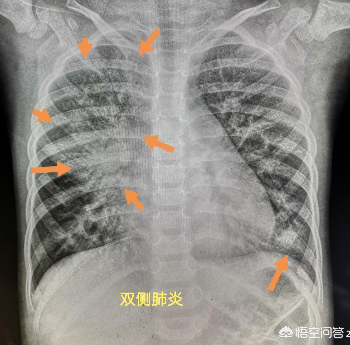 孩子得了肺炎一定要输液吗？医生：请避开这9个认知误区