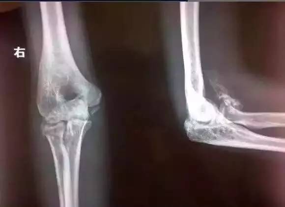 肘关节骨折僵硬锻炼之后手没力,肘关节撕裂骨折后关节响声