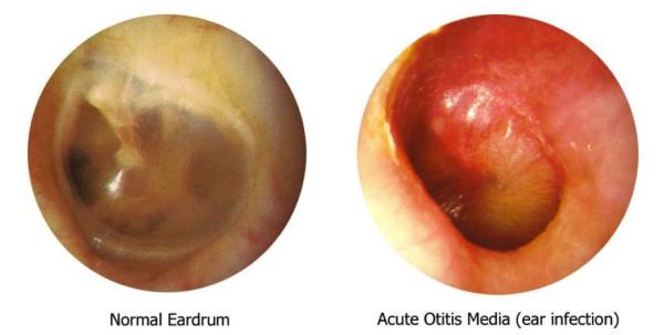 中耳炎预防小知识,儿童急性化脓性中耳炎健康宣教