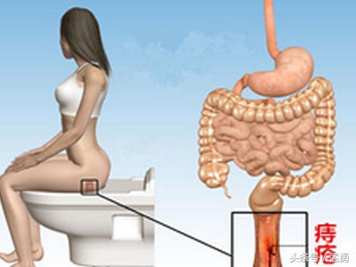二度痔疮的治疗方法,痔疮一物专治痔疮