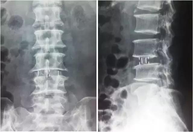 骨伤科可以治疗腰椎滑脱吗,腰椎滑脱微创术后需要康复训练吗