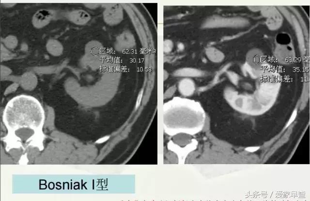布什还是奥巴马？放射科杨大夫谈体检查出的结节和囊肿