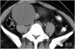 病例丨病理结果「医看」有奖阅片大赛病例资料8：右侧卵巢纤维瘤#医学影像#