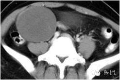病例丨病理结果「医看」有奖阅片大赛病例资料8：右侧卵巢纤维瘤#医学影像#