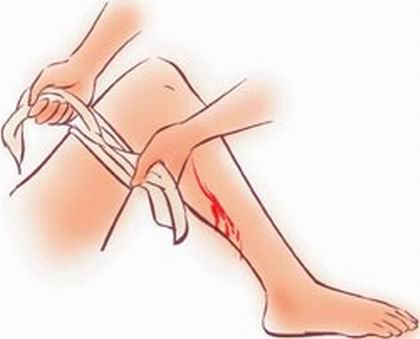 外伤急救的注意事项,急救知识伤口少量出血怎么处理