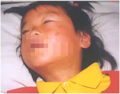 诊断麻疹最快速的方法,麻疹怎么做检测