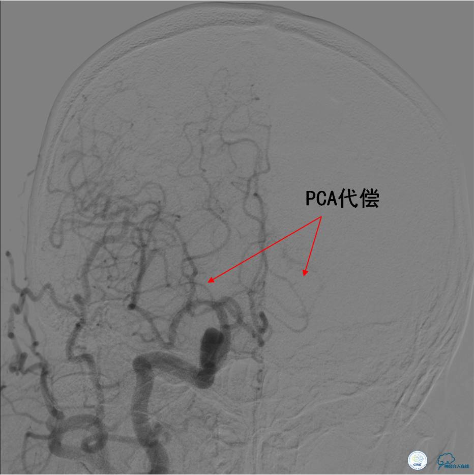 中医治疗基底动脉闭塞,基底动脉尖综合征病例分享