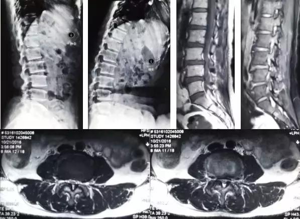 骨伤科可以治疗腰椎滑脱吗,腰椎滑脱微创术后需要康复训练吗