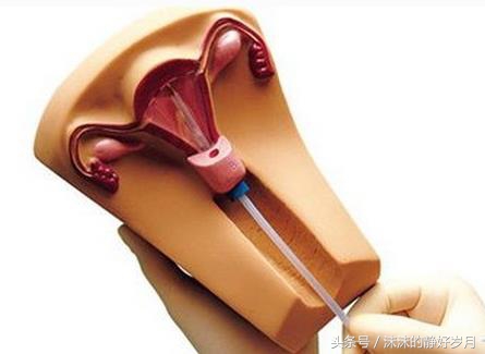 上环妈妈备孕二胎宝宝，先看看取环后多久才可以吧