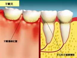 牙结石会导致牙齿脱落吗,牙结石自己脱落土偏方