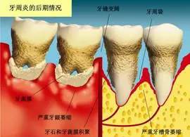 牙结石会导致牙齿脱落吗,牙结石自己脱落土偏方