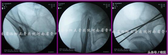 经皮置入术在骨盆髋臼骨折治疗中的应用骨医小灶第二十一期（中）