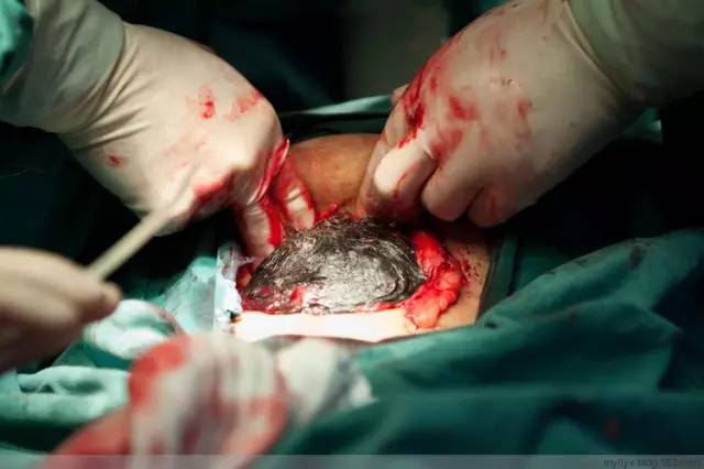 剖腹产恢复很好的照片,剖腹产完全恢复照片