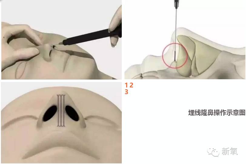 林允是不是整鼻子了,林允隆鼻过吗