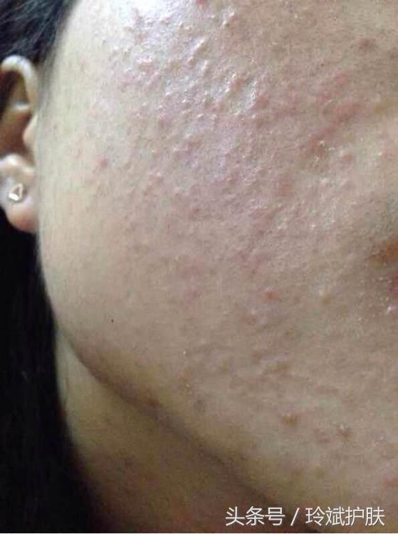 闭合性粉刺怎么去除额头,闭合性粉刺怎么去除