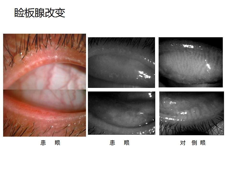 眼睑缘炎的发病原因,眼睑炎的症状和治疗方法