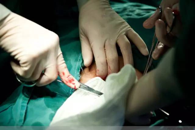 剖腹产恢复很好的照片,剖腹产完全恢复照片