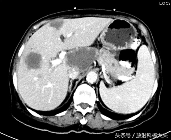 胃癌晚期出现肝转移中药保守治疗,无任何症状突然重度贫血