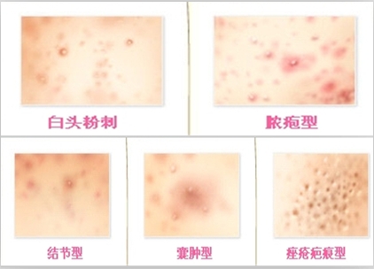 小孩脸上密密麻麻小疙瘩不痛不痒,脸上不痛不痒的小疙瘩是什么