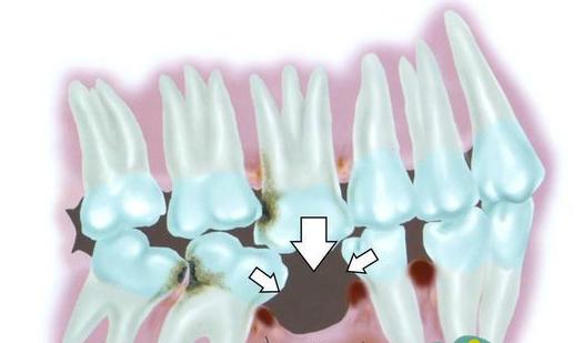 坏掉的牙齿拔掉,坏掉的牙拔掉为啥就不疼了
