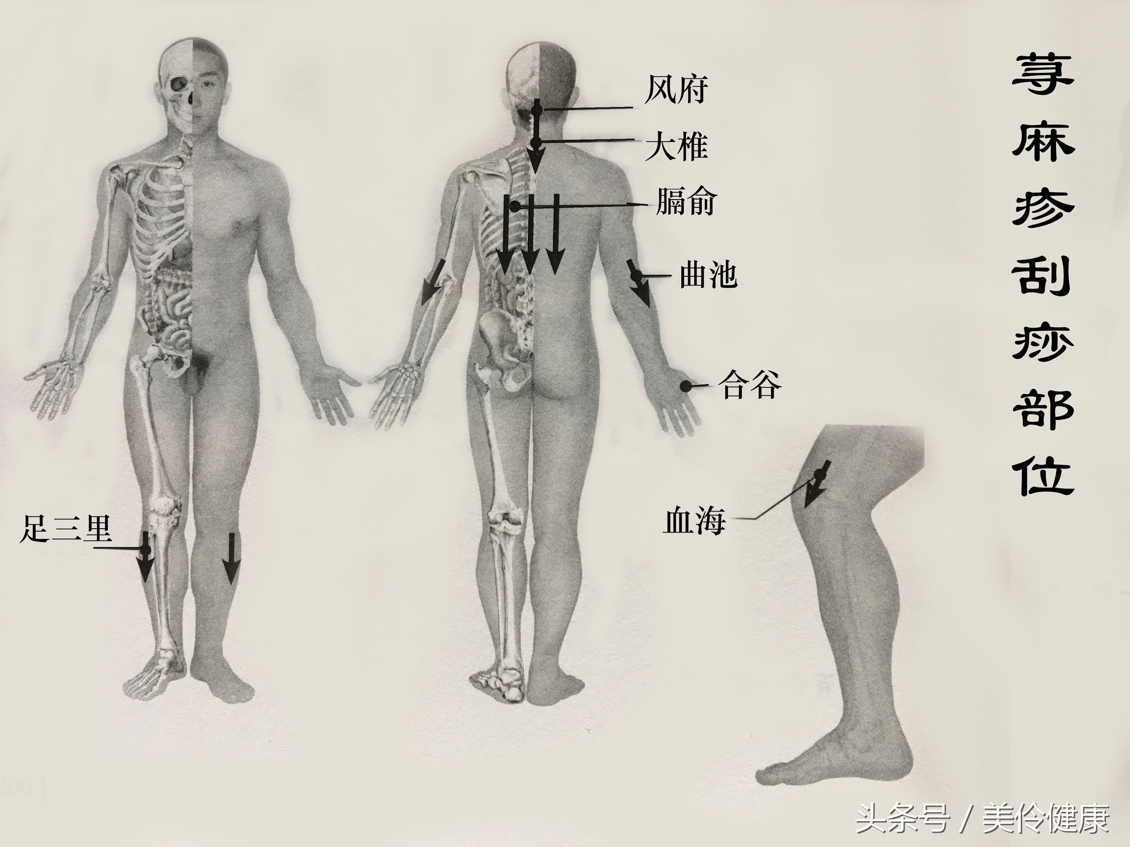 刮痧治疗白癜风偏方,荨麻疹刮痧疗法