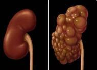 做彩超肝囊肿脂肪肝,肝做彩超有囊肿再做什么检查好