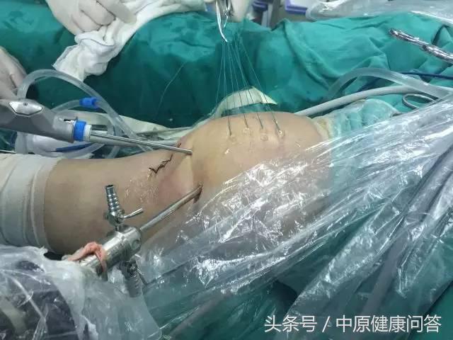 先天性习惯性流产,习惯性流产后期有可能会好吗