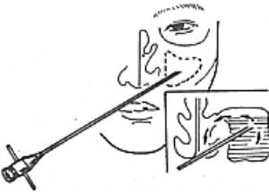 霉菌性上颌窦炎可以吃阿奇霉素,哪些生活习惯会引起霉菌性阴道炎
