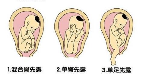孕妇胎位不正啥时纠正最好？