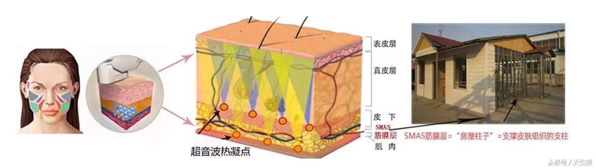 超声刀怎么样啊 (超声刀分享)