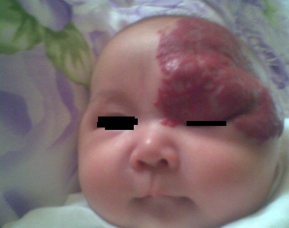 血管瘤严查,血管瘤怎么确定好坏