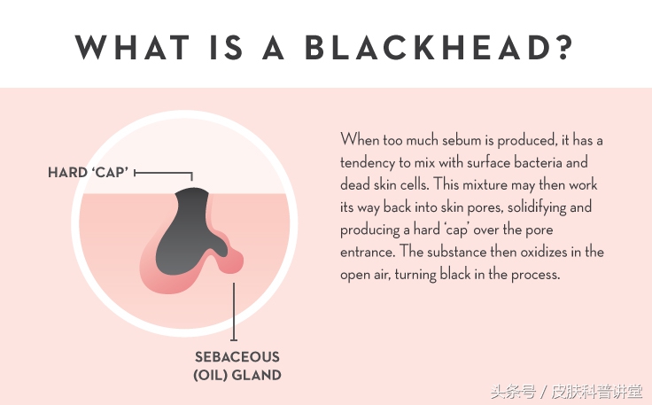 皮肤科鼻子毛孔粗大黑头怎么解决,黑头毛孔粗大出油皮肤科解决方法
