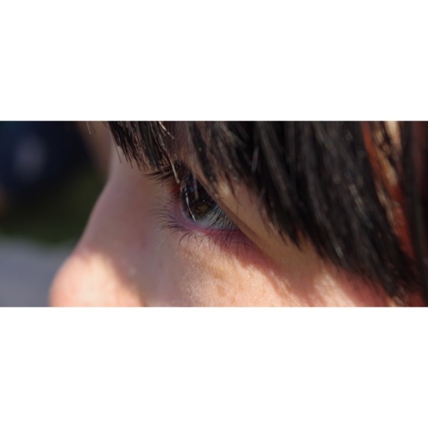 割完双眼皮后眼部吸脂,抽脂双眼皮做完眼睛有褶