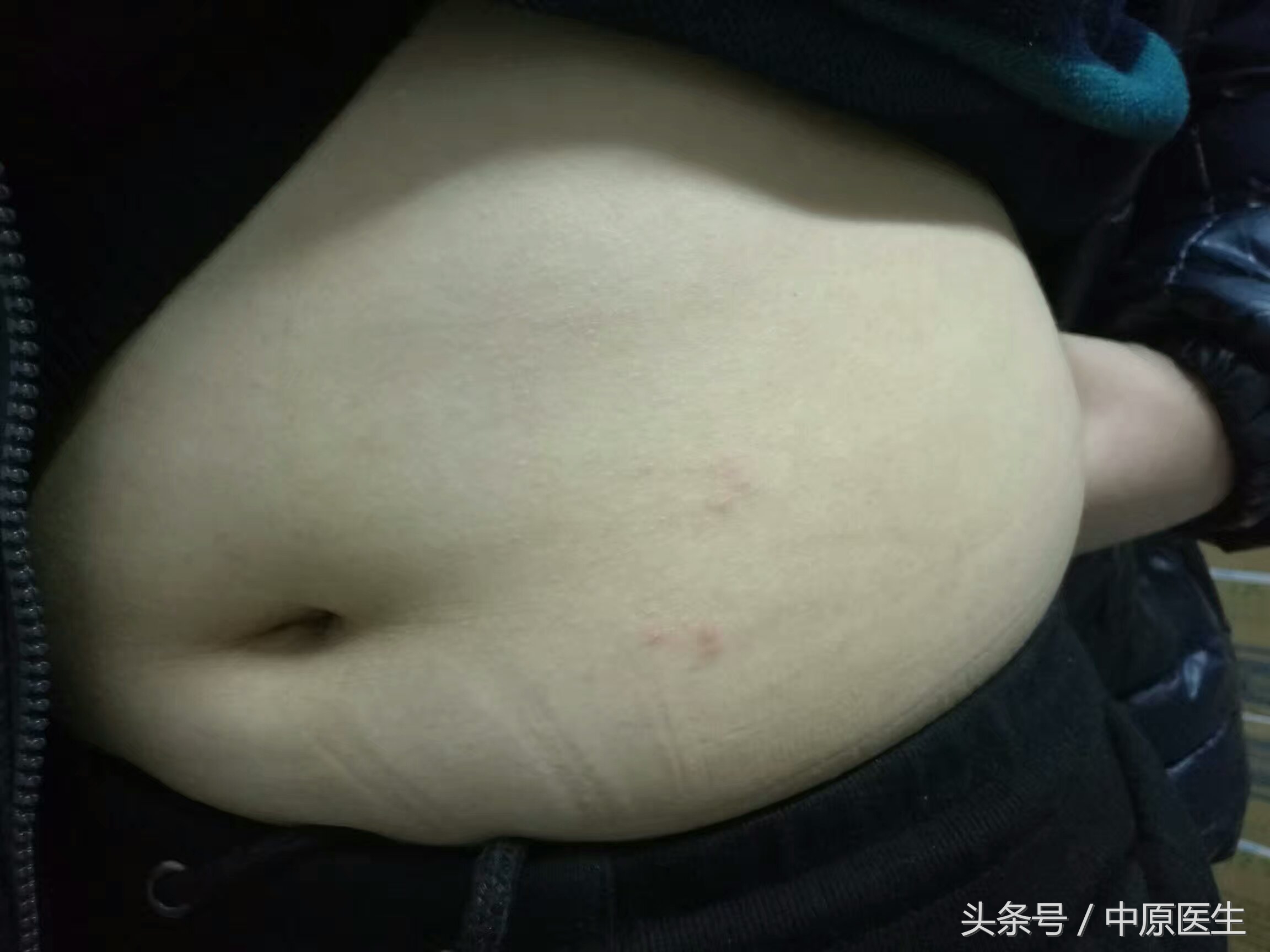 小孩感染了带状疱疹病毒的症状,14岁孩子得了带状疱疹怎么办