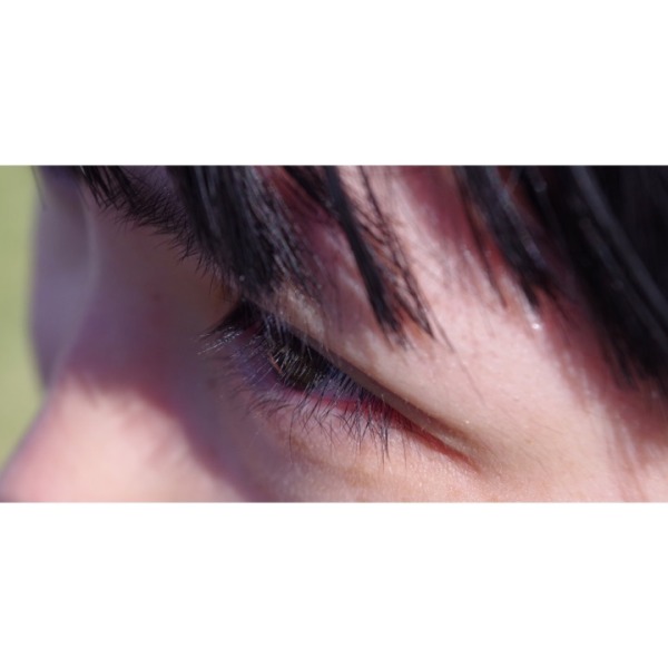 割完双眼皮后眼部吸脂,抽脂双眼皮做完眼睛有褶