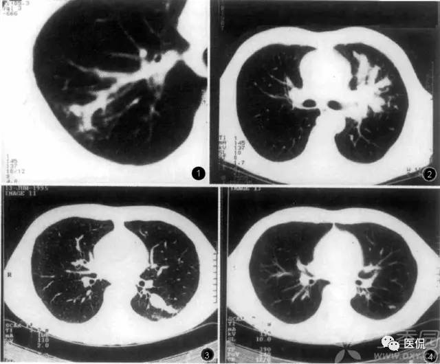 影像学呼吸系统理论知识,呼吸系统疾病影像学常见征象